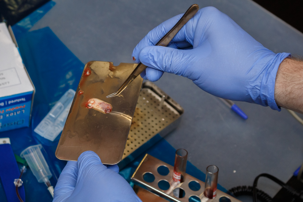 Атравматичное удаление зубов и методики наложения швов