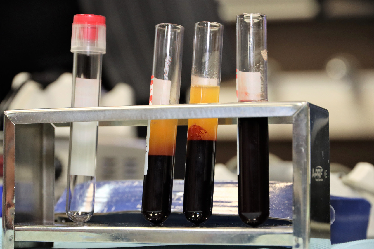 Плазмотерапия PRF в стоматологии