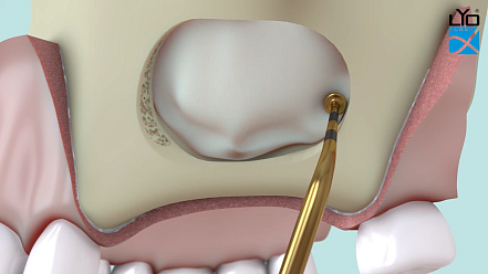 Пластика перфорации мембраны Шнейдера или профилактика перфорации при синус-лифтинге
