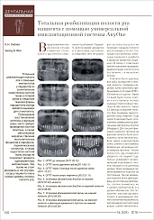 Тотальная реабилитация полости рта пациента с помощью универсальной имплантационной системы AnyOne