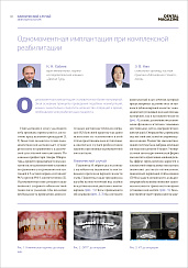 Одномоментная имплантация при комплексной реабилитации