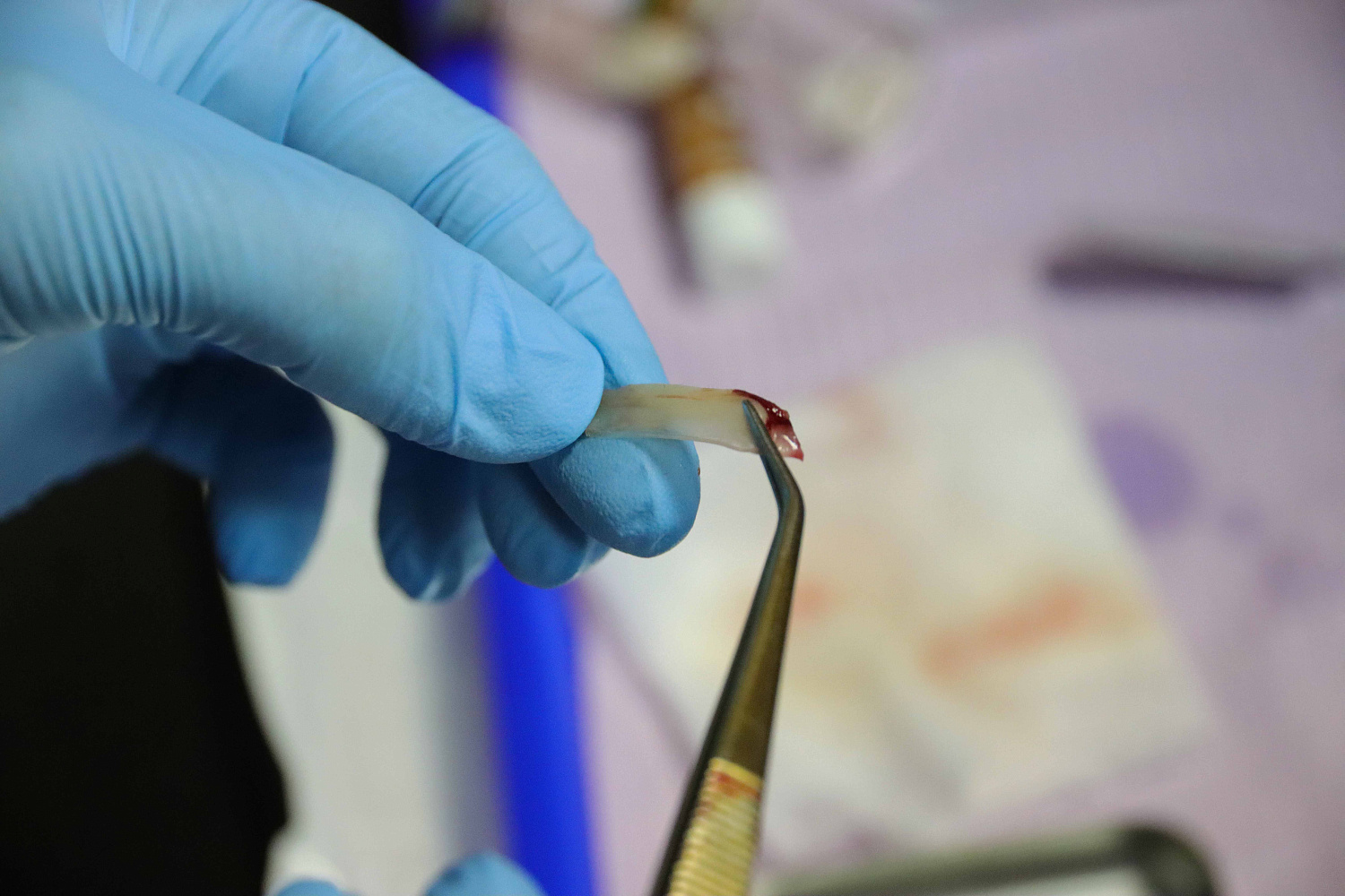 Плазмотерапия PRF в стоматологии