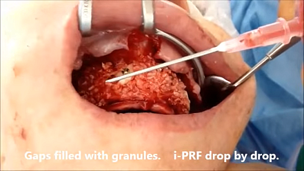 Клинический пример применения i-PRF 1